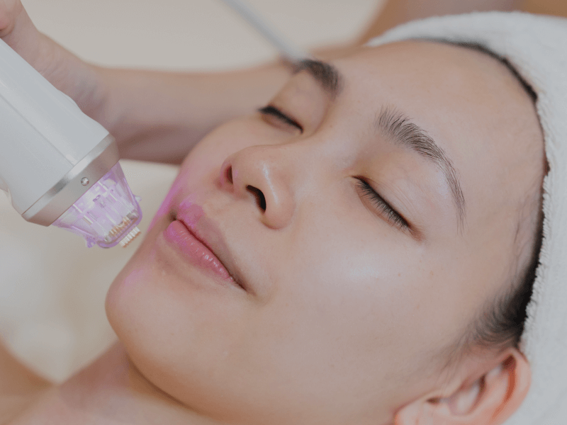 Microneedling Treatment