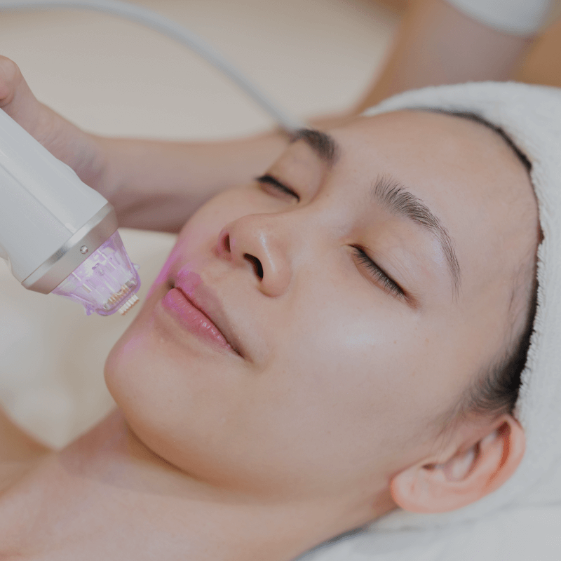 Microneedling Treatment