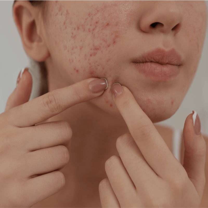 Acne Treatment Facial in Singapore