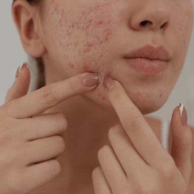 Acne Treatment Facial in Singapore