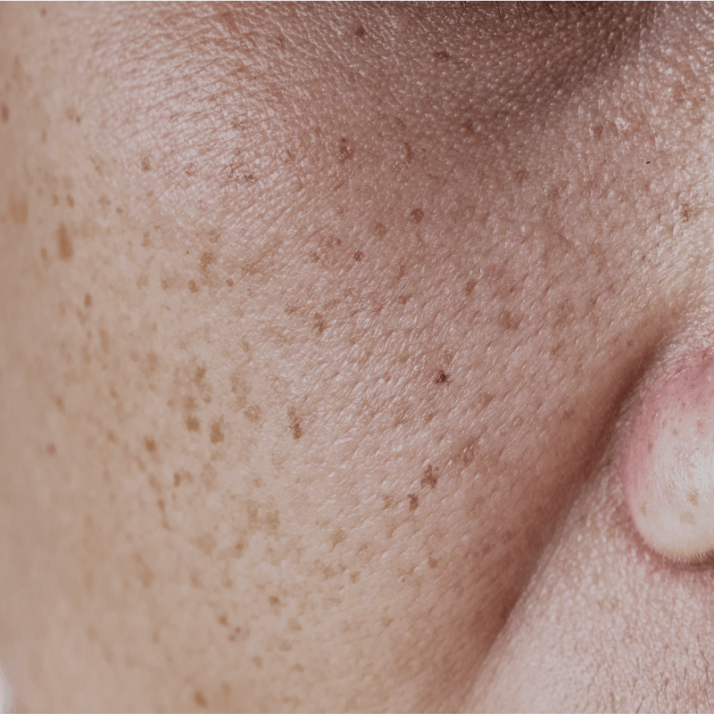 Skin Brightening Treatment